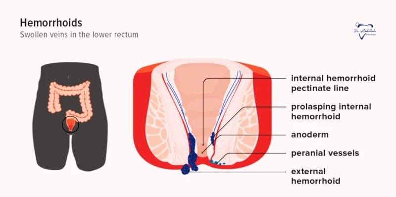 Symptoms and Causes of Bawaseer