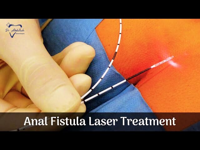 fistula laser treatment