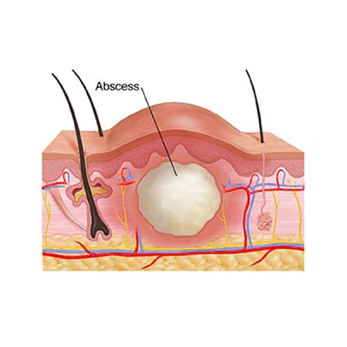 Perianal Abscess Surgery