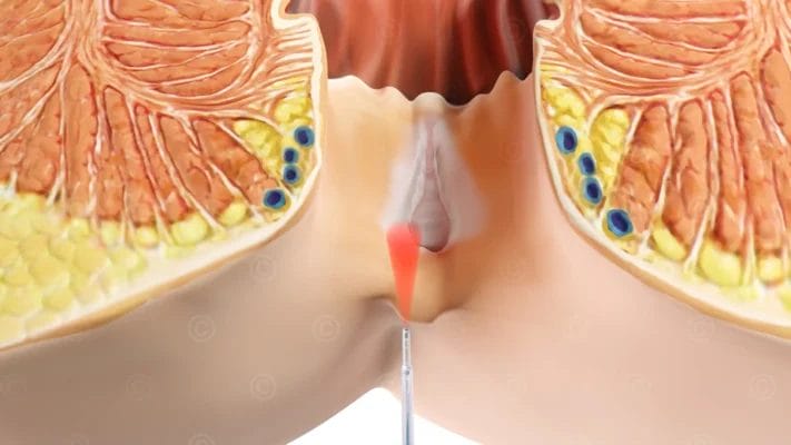 Anal Fissure Laser Treatment