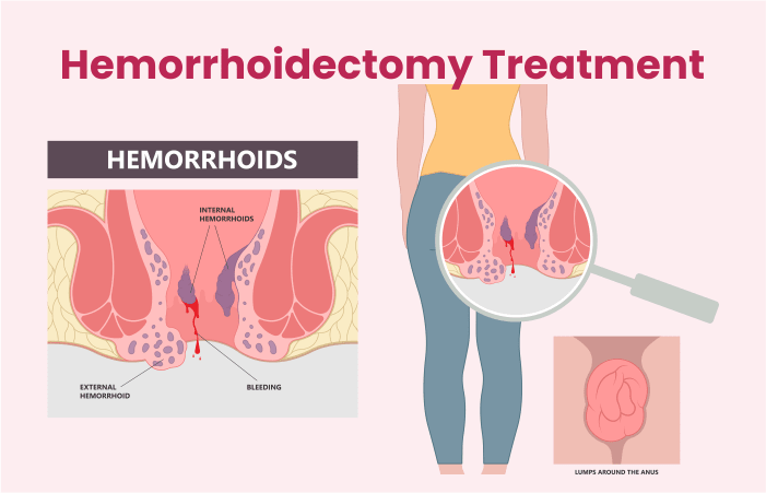 Hemorrhoids Treatment