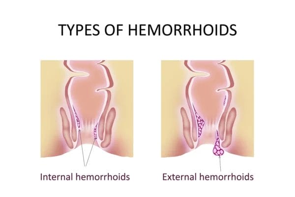 hemorrhoids meaning in urdu