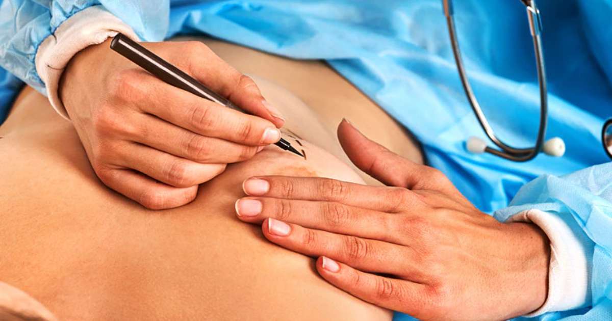 Breast surgery