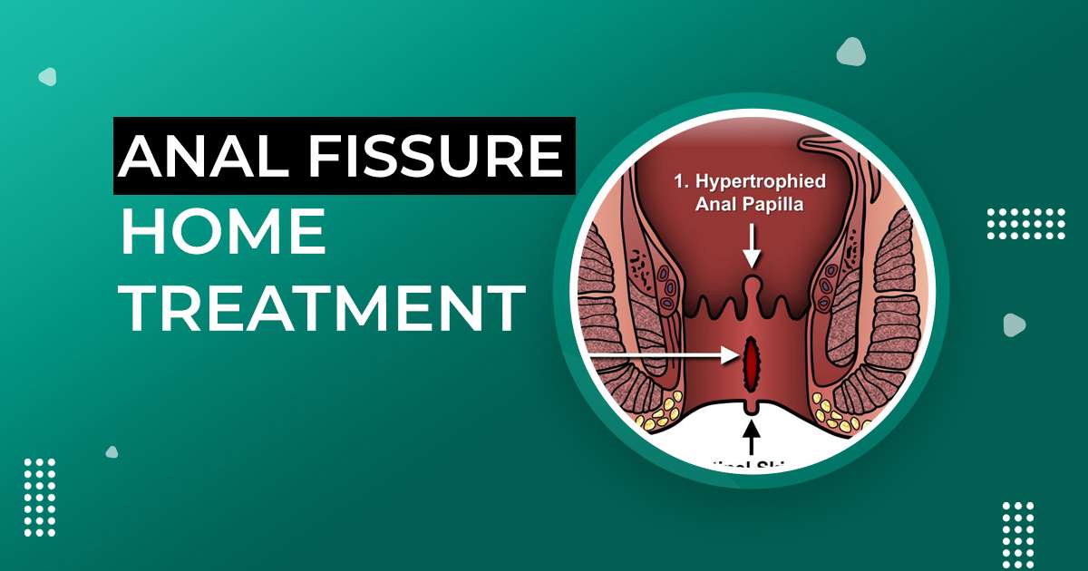 anal Fissure Home Treatment