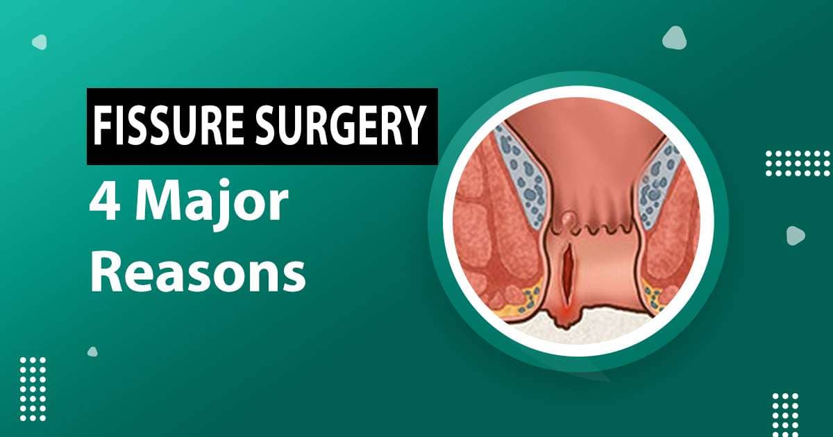 Fissure Surgery