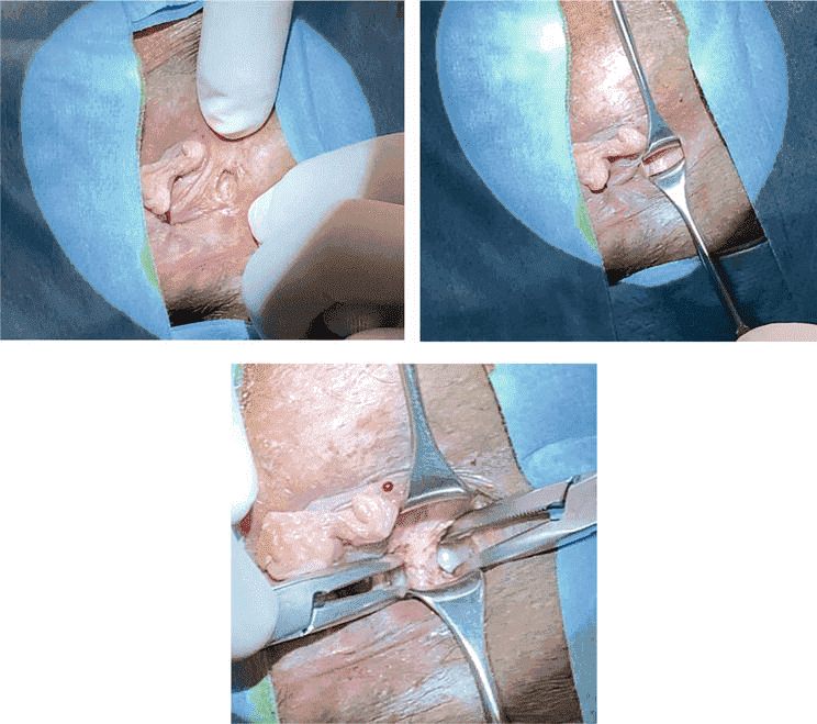 anal fissure surgery