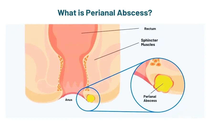 perianal abscess treatment