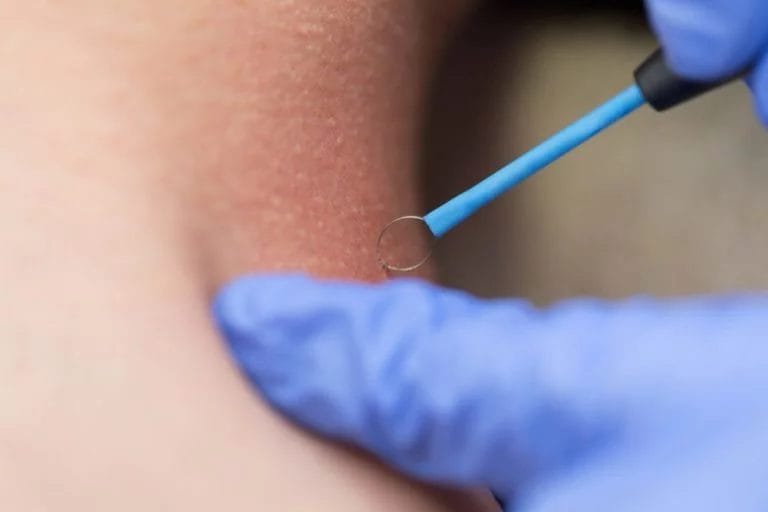 anal warts treatment