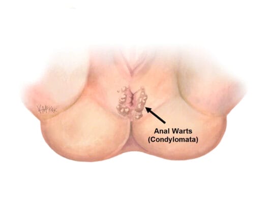 anal warts treatment
